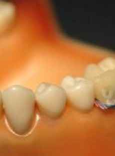 hygiene-vie-surveillee-implant-dentaire-01133238